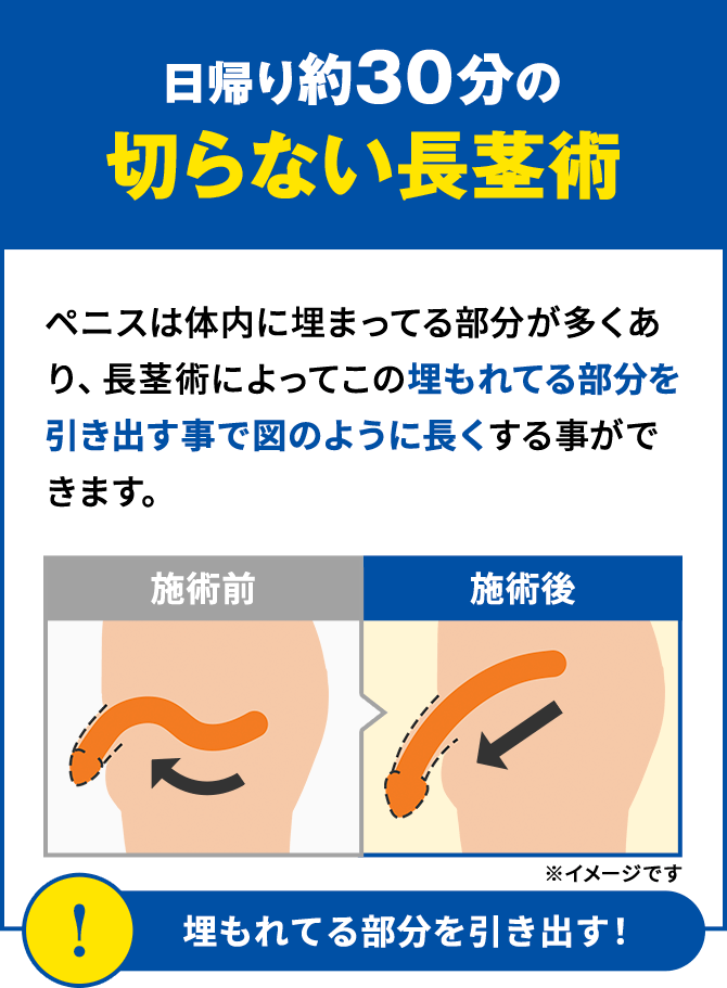 日帰り約30分の切らない長茎術